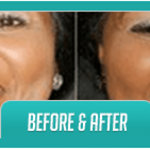 Before and After Teeth Whitening | Dores Dental - Longmeadow, MA Dentist