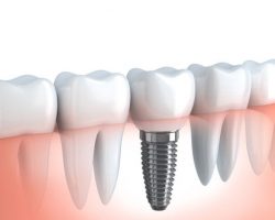 Dental Implants 2 | Dores Dental - East Longmeadow, MA