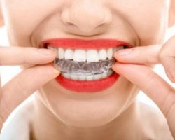 Invisalign Thumbnail 2 at Dores Dental | East Longmeadow, MA Invisalign Thumbnail 2 at Dores Dental | East Longmeadow, MA