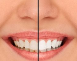 Before and After Teeth Whitening | Dores Dental - Longmeadow, MA Dentist